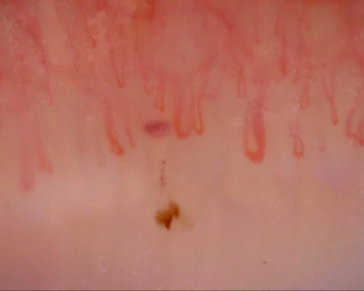 Enlarged capillary loops and hemorrhagic spots in the left ring finger at the initial examination of a girl with MCTD