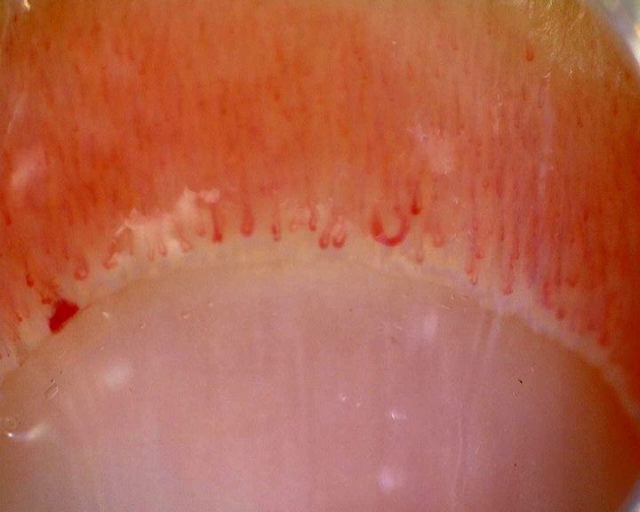 Overview of the nailfold in the ACA-positive active-pattern case. The reported density and giant-capillary percentage describe the study, not this photograph alone.