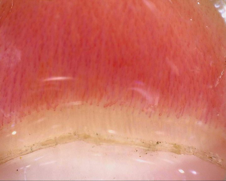 Follow-up overview from the same mixed connective tissue disease case. The linked report places this image in the clinical and longitudinal context.