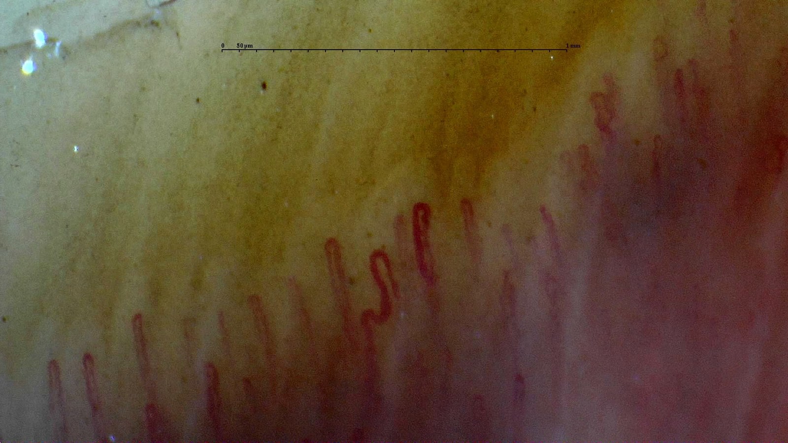 Skin phototype example