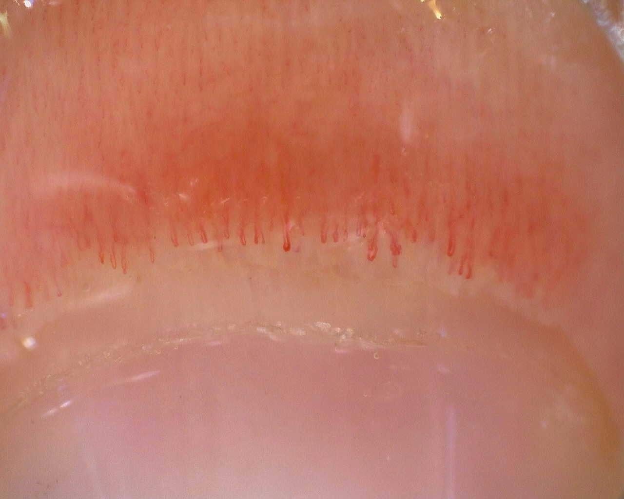 Initial nailfold overview in the juvenile anti-NXP2 longitudinal case. Compare the follow-up and the documented quantitative findings in the complete case.