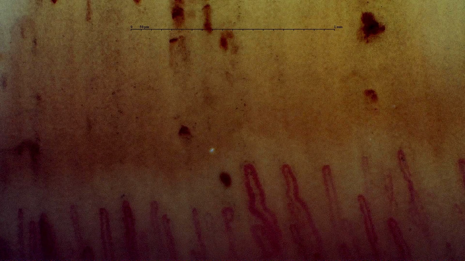 Skin phototype example