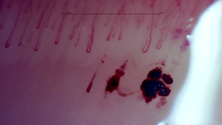 Large dark hemorrhagic deposits below the capillary row in the published MPO-ANCA vasculitis case. Its complete study is described as a nonspecific pattern without giants.