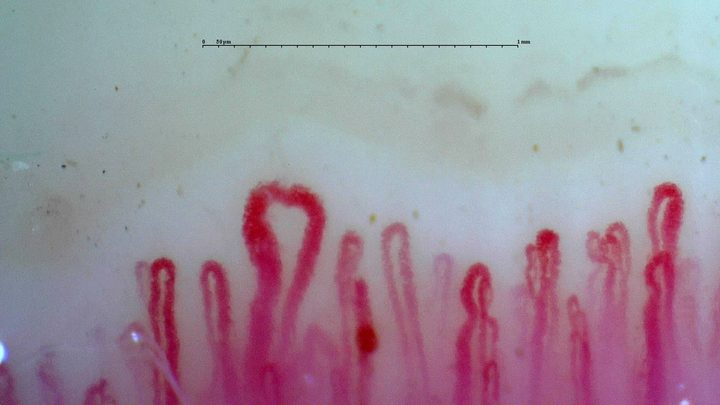 A prominent enlarged loop in the active-pattern reference study. Compare the neighboring capillaries and the other fields before assigning a pattern.