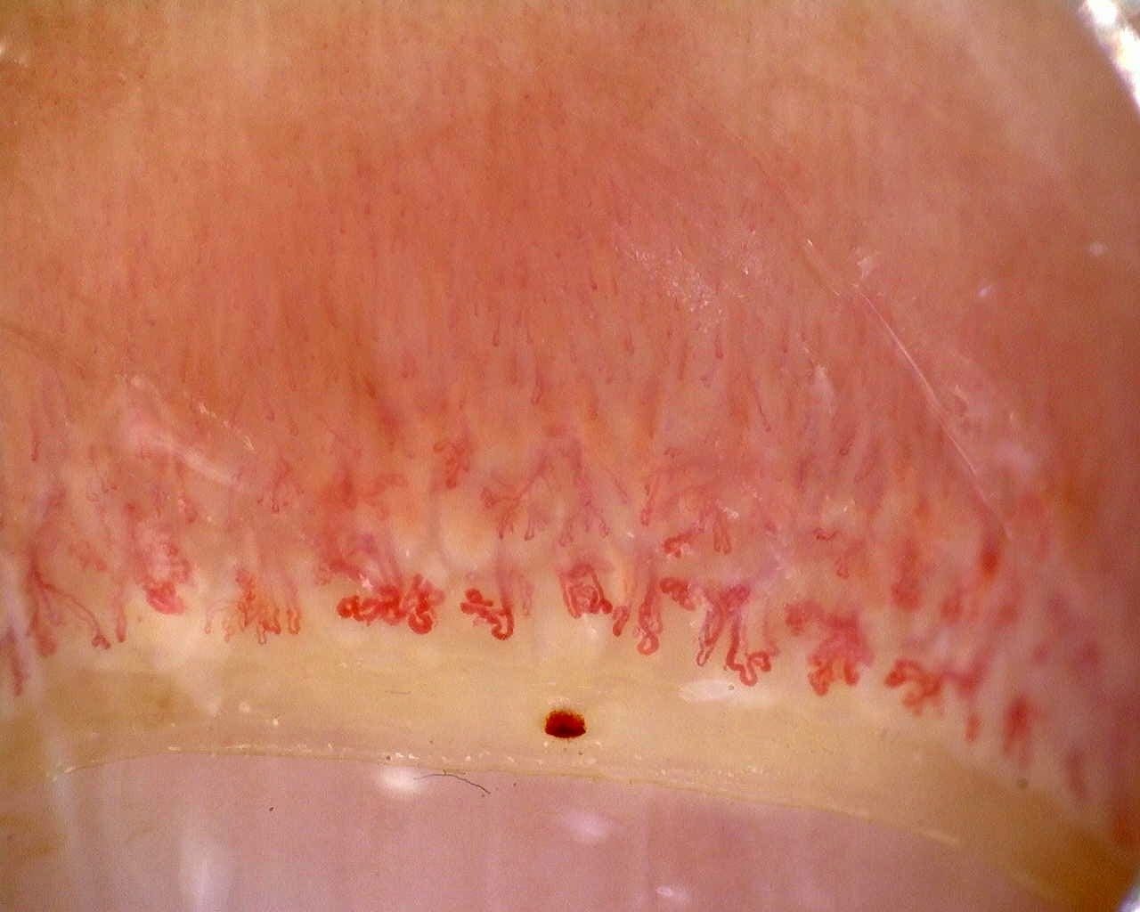 Anti-Mi2β Dermatomyositis in Active Disease