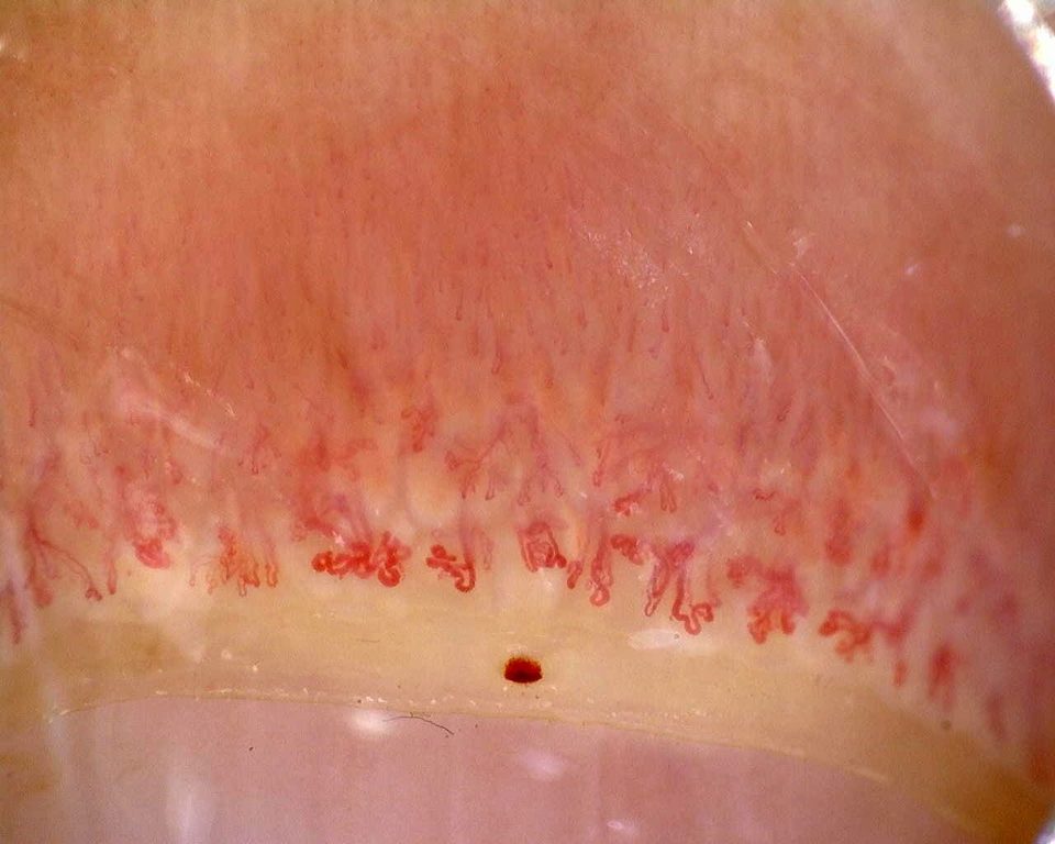 Preview image for Anti-Mi2β Dermatomyositis in Active Disease