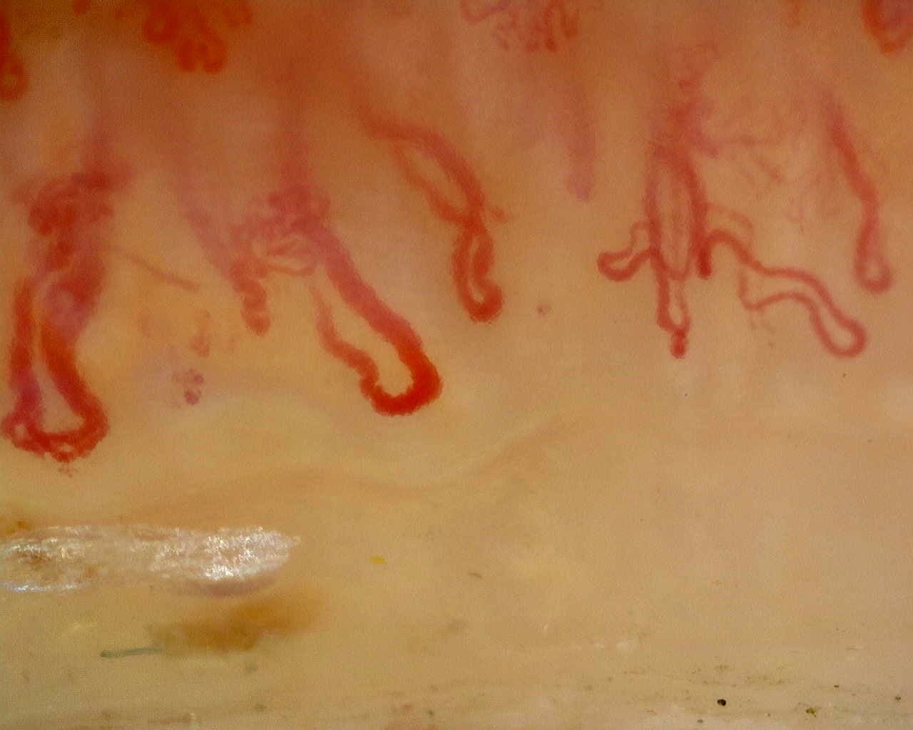 Late pattern with rarefaction and abnormal shapes