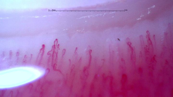Follow-up field from the adult anti-NXP2 dermatomyositis case. The source report documents improved study-wide density and disappearance of giants and hemorrhages; these are longitudinal study findings.