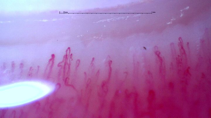 Follow-up field from the adult anti-NXP2 dermatomyositis case. The source report documents improved study-wide density and disappearance of giants and hemorrhages; these are longitudinal study findings.