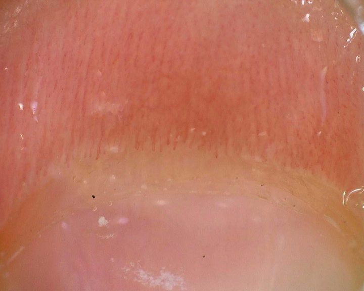 Follow-up nailfold overview from the same juvenile anti-NXP2 case. Differences in overview appearance should be interpreted alongside acquisition conditions and the serial reports.