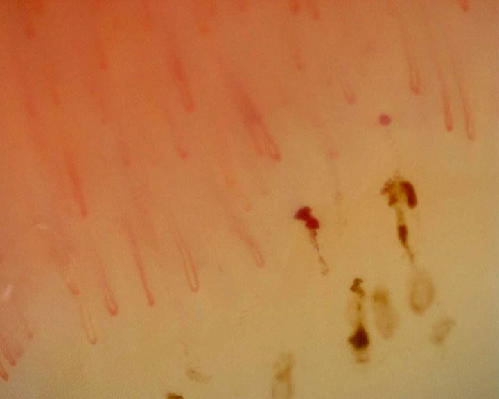 Dark hemorrhagic deposits alongside capillary loops in the nonspecific reference study. Hemorrhage alone does not define a scleroderma pattern.