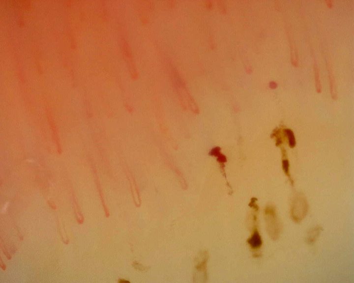 Dark hemorrhagic deposits alongside capillary loops in the nonspecific reference study. Hemorrhage alone does not define a scleroderma pattern.