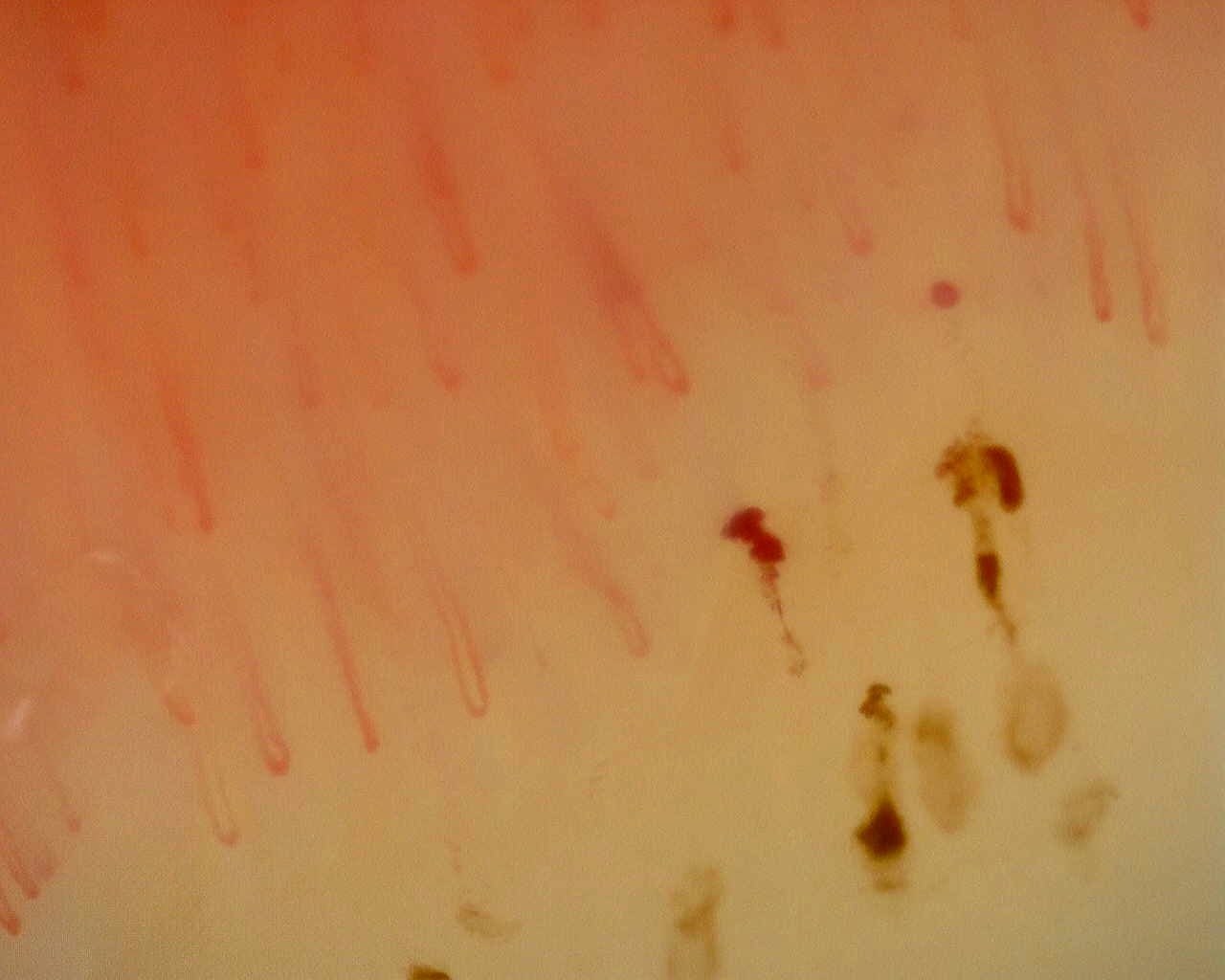 Morphological example of nonspecific microangiopathy with preserved density, hemorrhages, and tortuosity