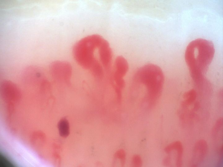 200x nailfold capillaroscopy field with large megacapillaries in an active scleroderma pattern