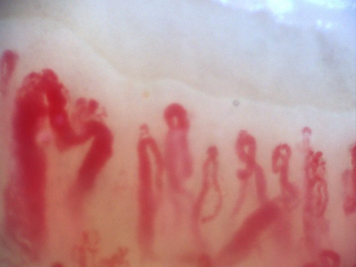 200x nailfold capillaroscopy field with several megacapillaries in an active scleroderma pattern