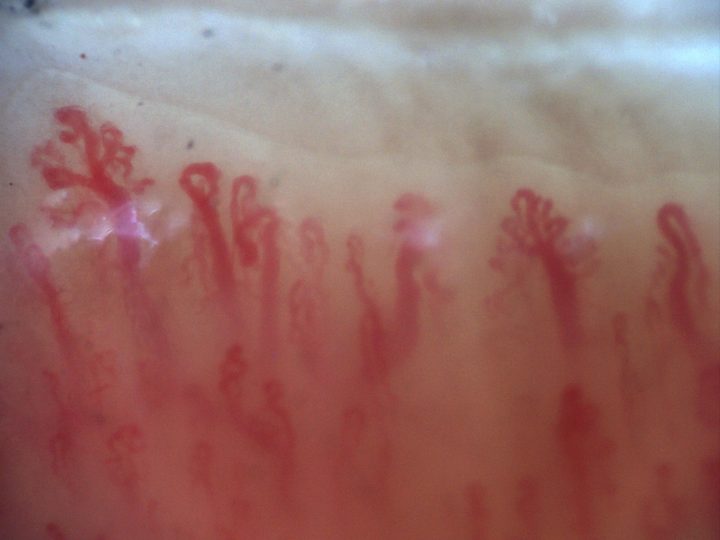 200x nailfold capillaroscopy field with a branching capillary on the left side