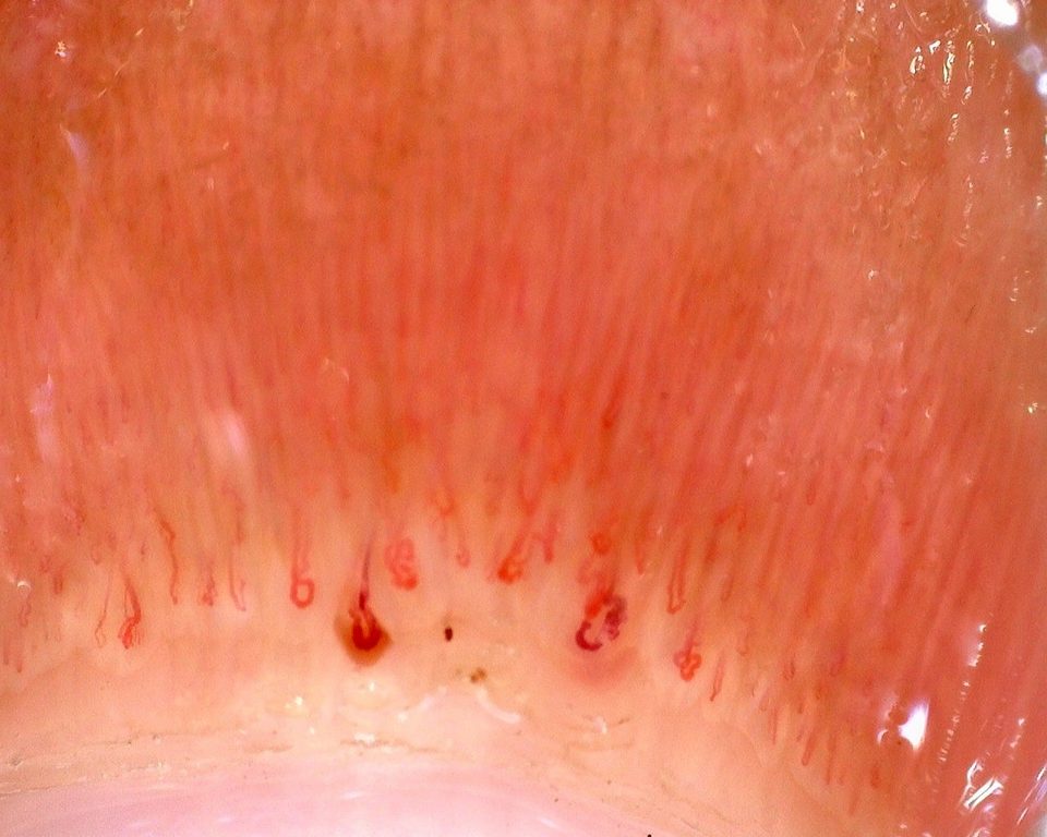 Preview image for Juvenile Dermatomyositis with Gottron Lesions and a Scleroderma-Like Pattern