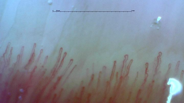 A field from the normal reference study, showing the distal row of narrow loops. Use the full study to compare density and shape across fingers.