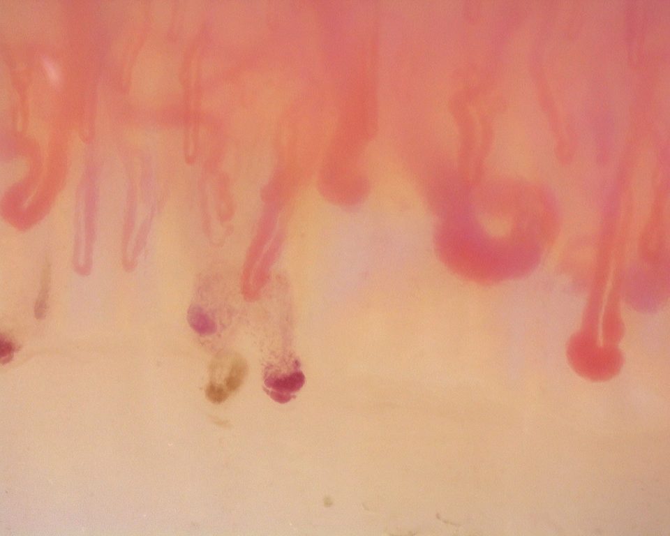 Preview image for Diffuse Systemic Sclerosis (Anti-Scl-70+) with Active Cutolo Pattern