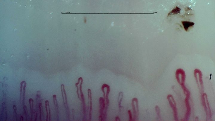 Selected field from the early-pattern reference study, with enlarged loops among a relatively preserved capillary row. The subtype belongs to the complete examination.