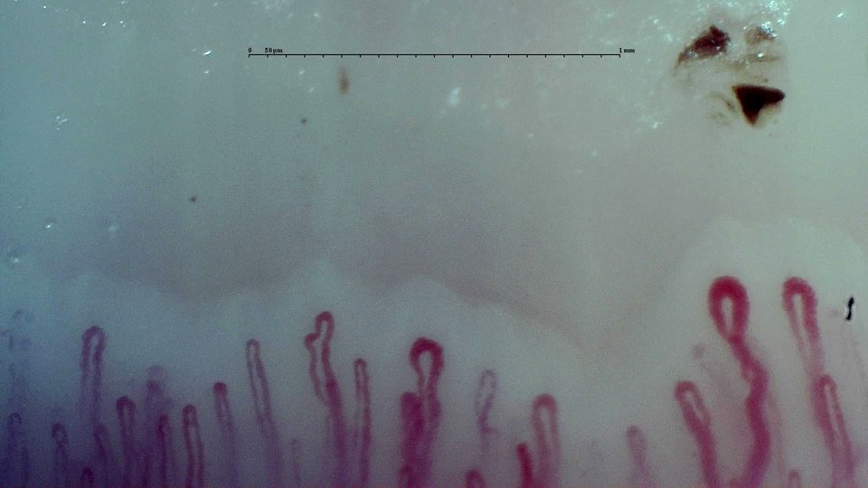 Preview image for Early SSc Cutolo Pattern: Representative Case