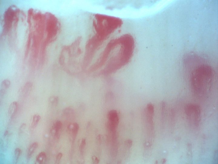 200x capillaroscopy field in systemic sclerosis showing megacapillaries, pericapillary edema, and a ground-glass stromal pattern