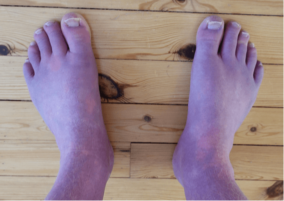 Clinical acrocyanosis in feet