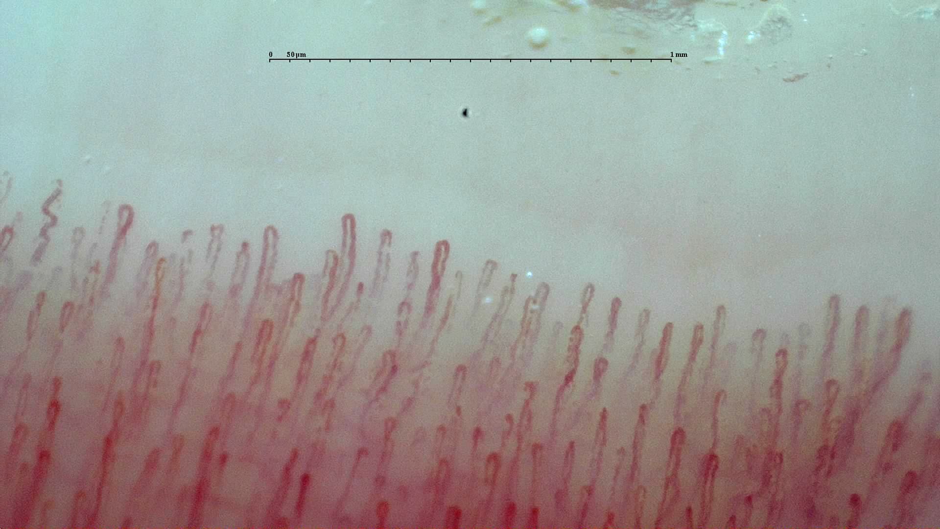 Normal capillaroscopy