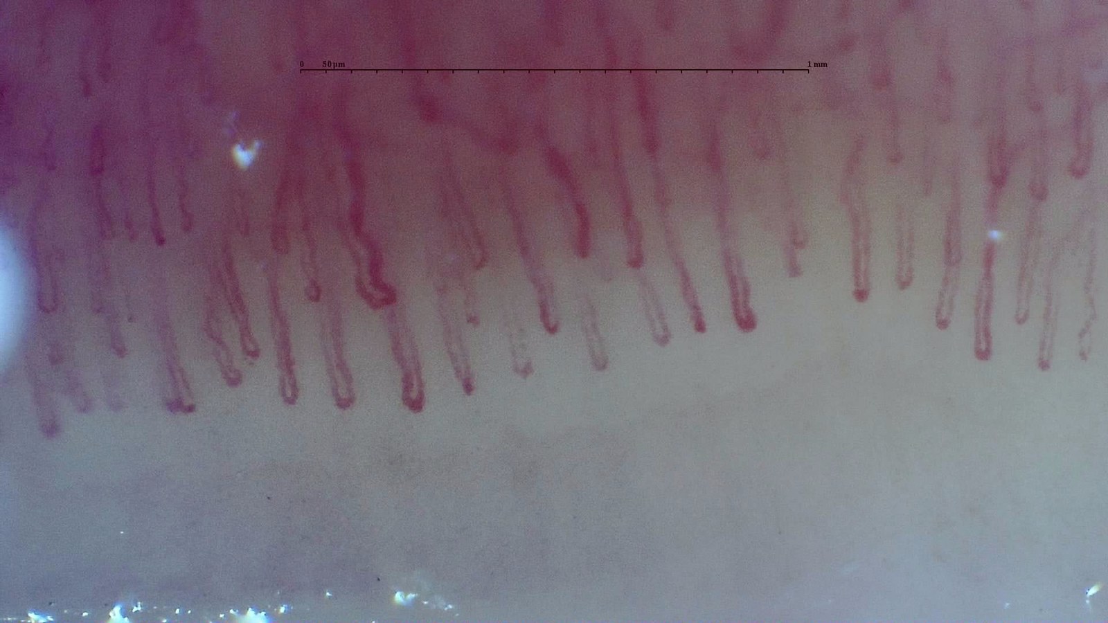 Normal capillaroscopy