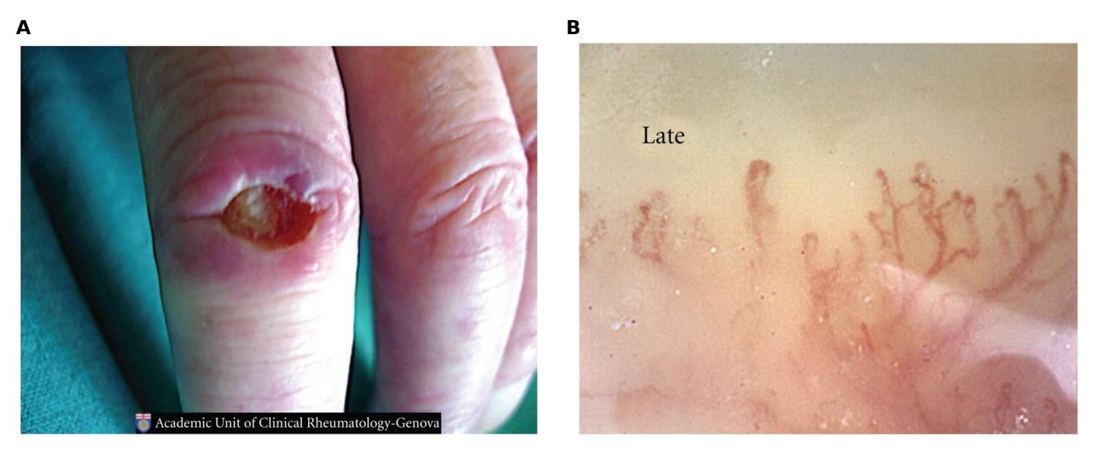 Figure 1. Digital ulcer and late pattern
