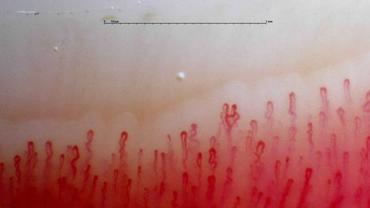 A capillary with two rounded apices near the center-right, among shorter tortuous loops.