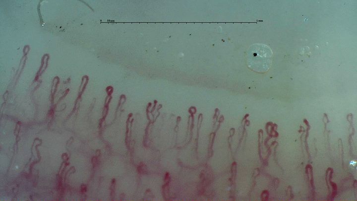 A small branching-appearing capillary near the center, with crossed, curved and folded loops nearby.