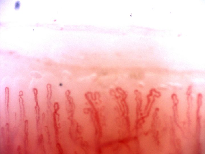 Small branching capillaries in the center and right, mixed with narrow hairpin loops and crossed capillaries.