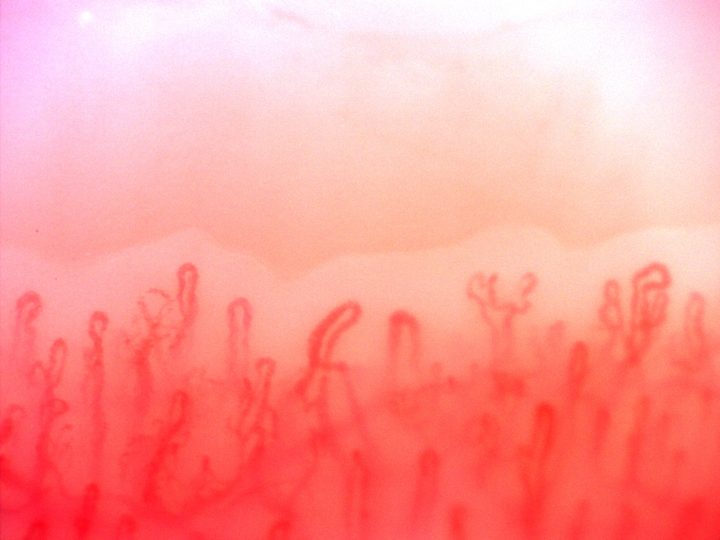 Small capillaries with multiple or bifurcated apices, mixed with simple rounded hairpin loops.