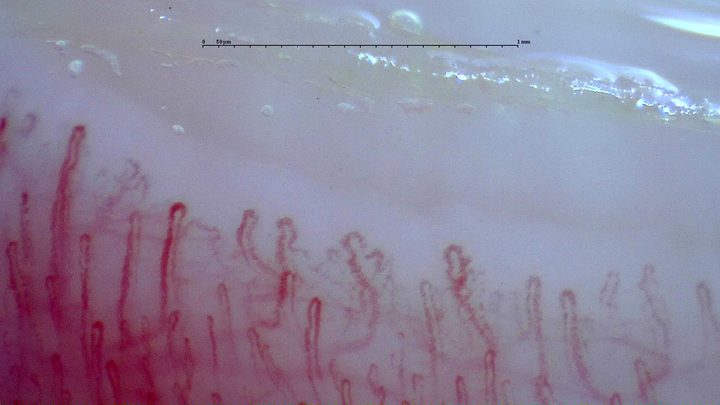 Fine capillaries with accessory loops and multiple apices, mixed with longer hairpin loops. Some vessels overlap.