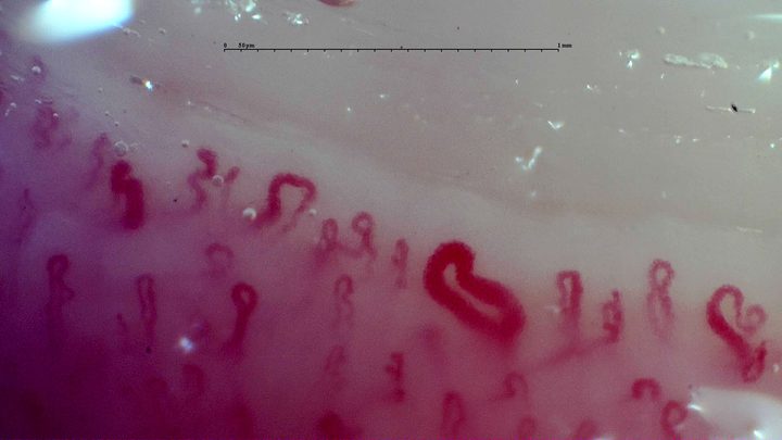 A tortuous giant-appearing capillary near the center-right, with a thick apex and limbs. Smaller coiled loops are visible nearby.