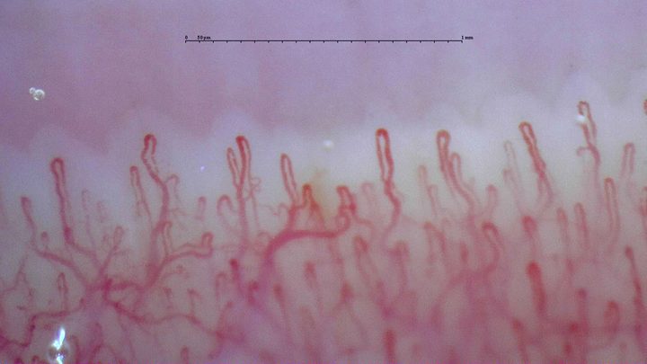 Rounded hairpin capillaries with some curved or overlapping limbs. The deeper vascular network is visible.