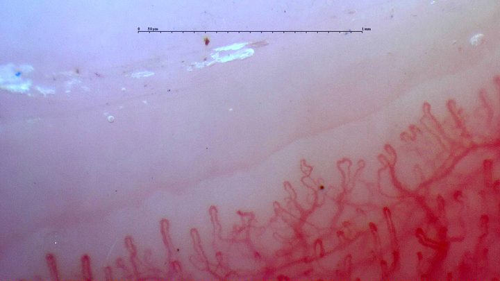 Capillaries with paired or accessory apices, especially on the right, mixed with simple hairpin loops.