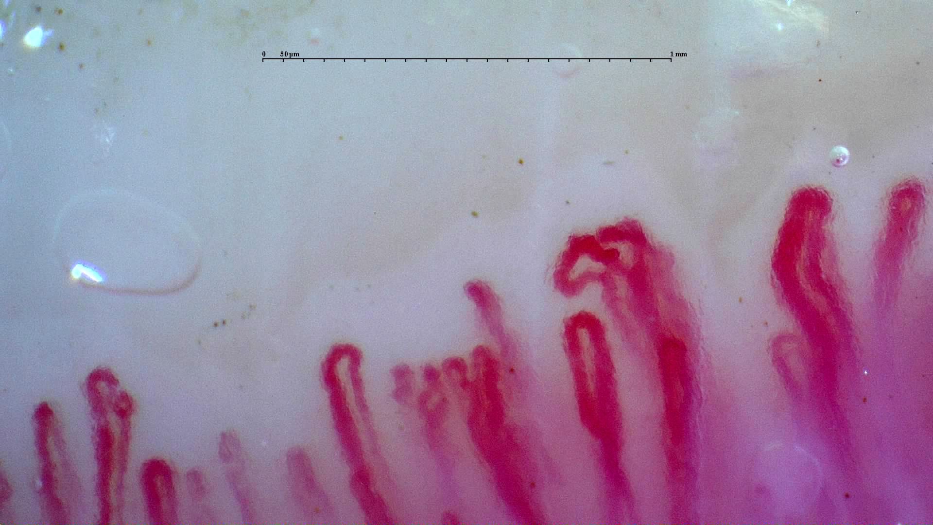 Several giant-appearing capillaries with thick limbs and broad or folded apices, mixed with narrower loops.