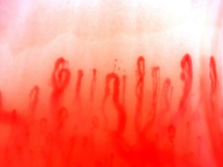 Giant-appearing capillaries in the center and right, with narrow hairpin loops and a crossed capillary on the left.