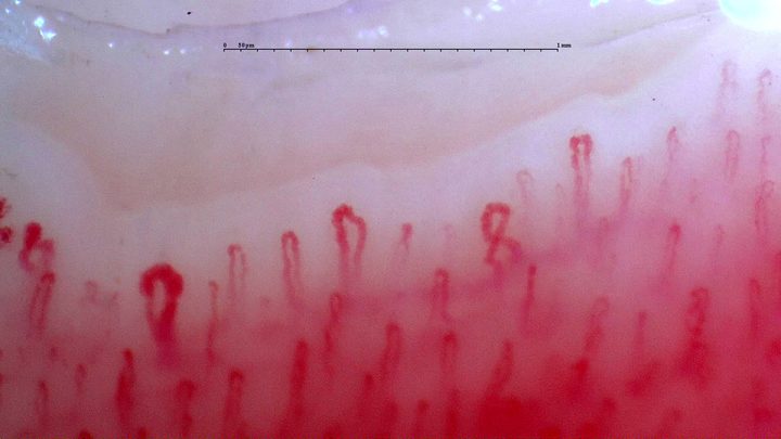 An enlarged rounded apex on the left, with crossed and mildly tortuous capillaries nearby.