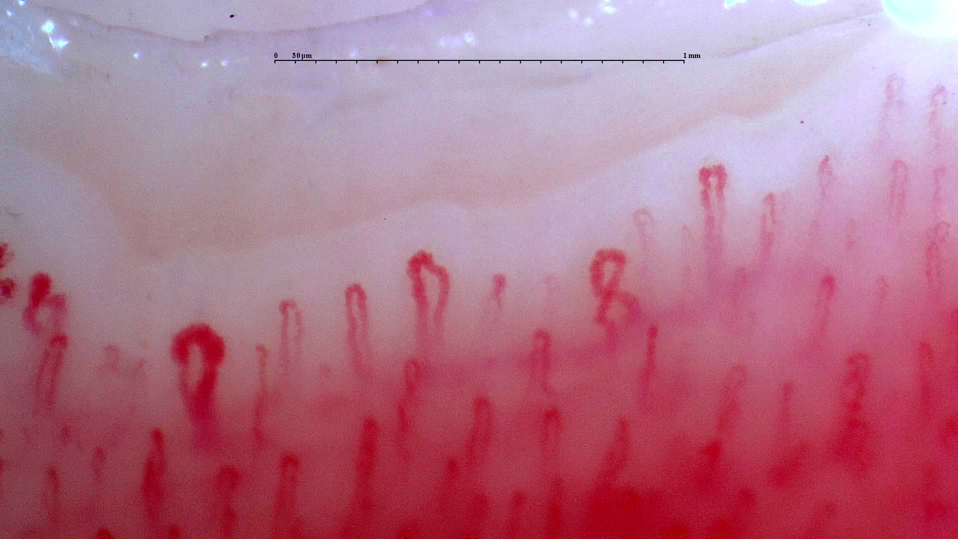 An enlarged rounded apex on the left, with crossed and mildly tortuous capillaries nearby.