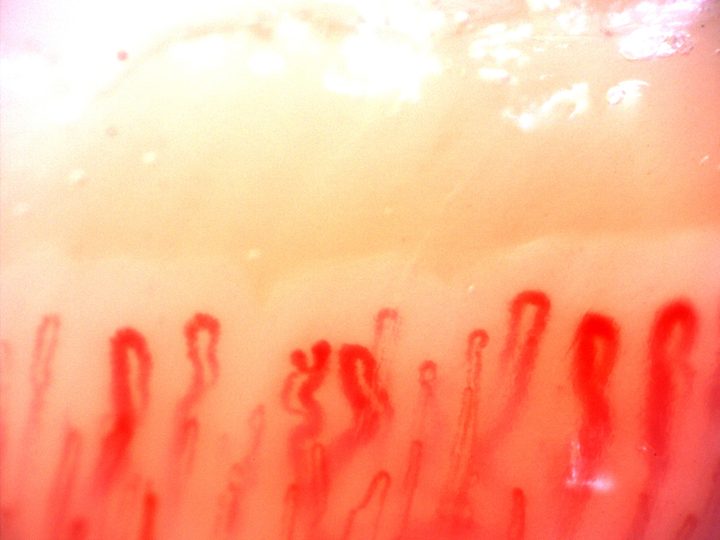 Several giant-appearing capillaries with broad rounded apices, especially on the right. A folded loop is visible in the center.