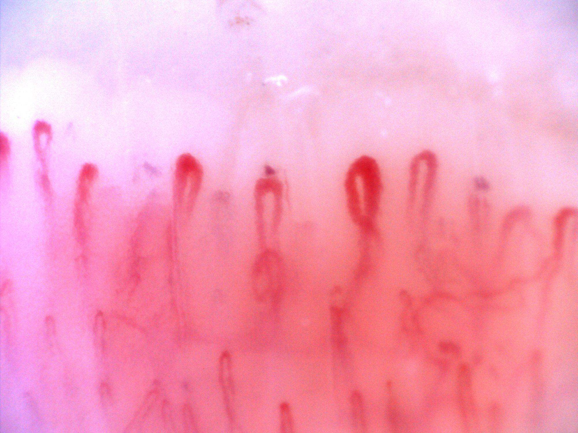 An oval giant-appearing capillary right of center and another enlarged apex on the left, among finer hairpin loops.