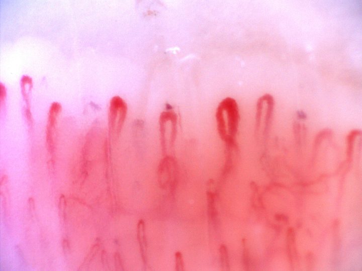An oval giant-appearing capillary right of center and another enlarged apex on the left, among finer hairpin loops.