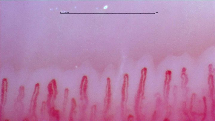 Enlarged hairpin capillaries, some with tortuous limbs, especially on the left.