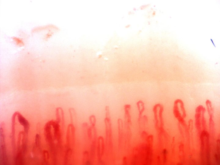 Two giant-appearing capillaries on the left, fine hairpin loops in the center and an oval crossed capillary on the right.