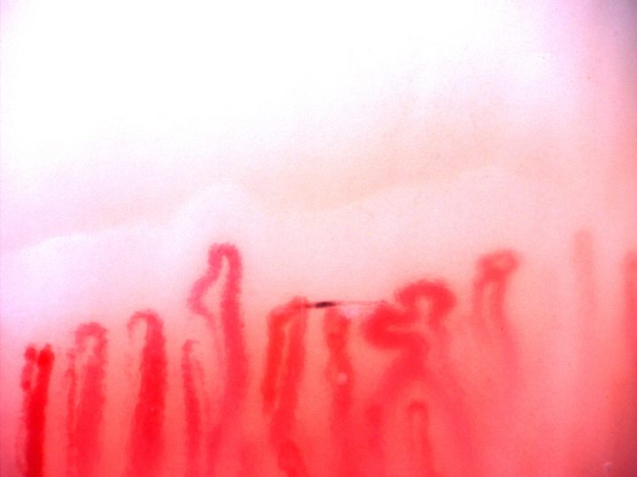 A folded giant-appearing capillary near the center-right, with several enlarged loops nearby.