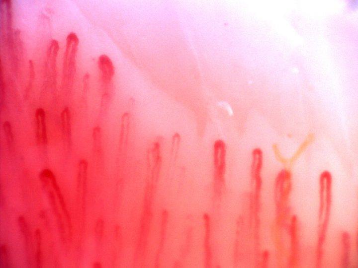 Hairpin capillaries of different lengths and apical widths. A pale surface strand overlies some right-sided loops.