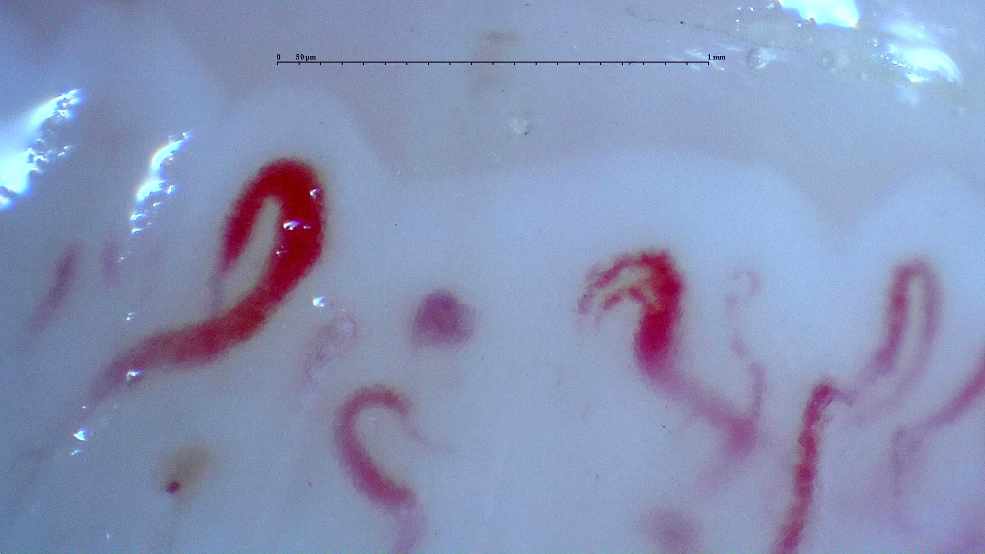 A giant-appearing capillary on the left and other asymmetrically enlarged loops. A small reddish-brown deposit below may represent a microhemorrhage.